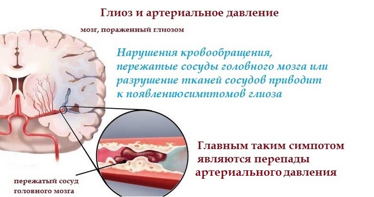 Очаг более вероятно сосудистого. Глиоз артерий головного мозга. Глиоз лобной доли. Глиозные очаги головного мозга. Единичные очаги глиозной трансформации головного мозга.