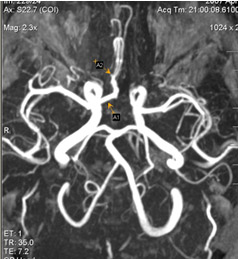 Сегмент а1 пма. Передняя трифуркация ПМА. Аплазия а1 сегмента правой передней мозговой артерии.