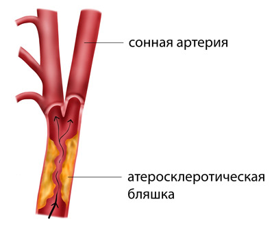 Процент стеноза сосудов. Атеросклероз сосудов сонных артерий. Холестериновая бляшка в сонной артерии. Атеросклеротическая бляшка в сонной артерии.