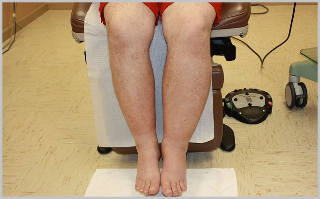 De ce un picior fierbinte în varicoza Ce este varicoza?