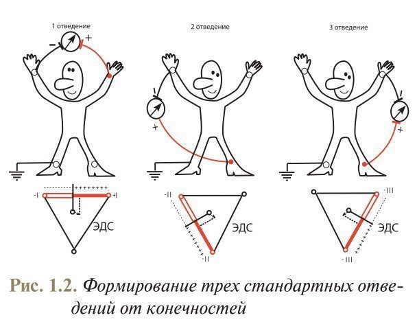 Низкоамплитудные отведения экг