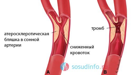 Артерия тромб удаление. Атеросклероз стеноз сонных артерий операция. Атеросклероз сосудов бца. Атеросклероз брахиоцефальных артерий со стенозом. Операция атеросклероза сонной артерии.