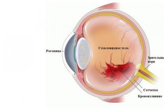 Moždani udar oka: uzroci, simptomi, liječenje patologije Moždani udar u oku šta piti
